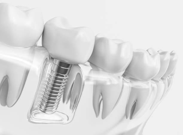 Implanty zębów – kiedy warto je wybrać? Wskazania, zabieg, cena